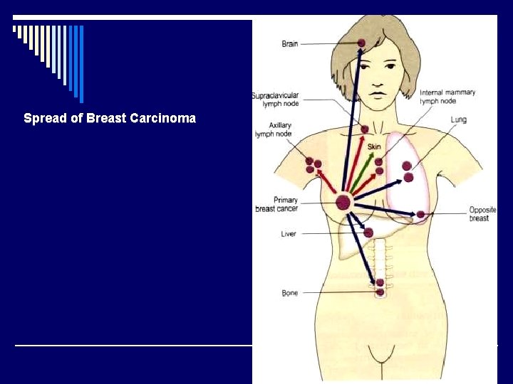 Spread of Breast Carcinoma 