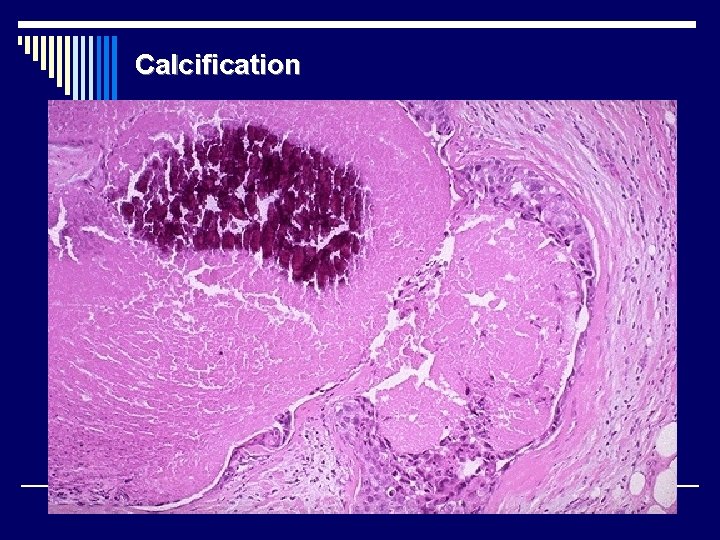 Calcification 