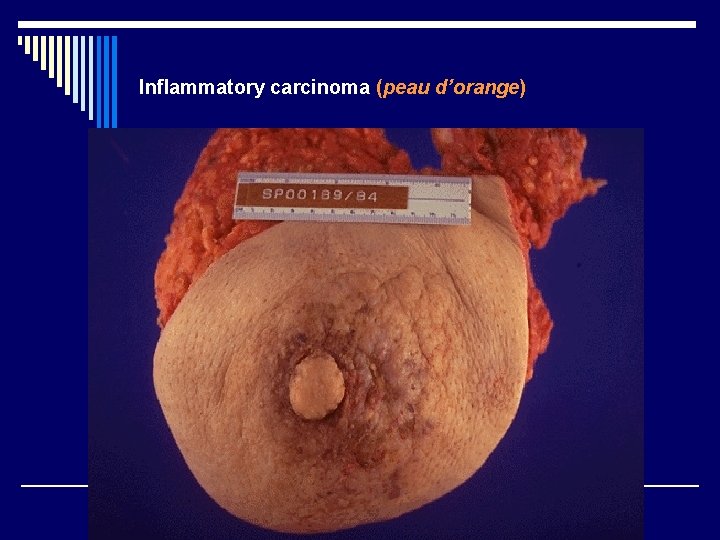 Inflammatory carcinoma (peau d’orange) 