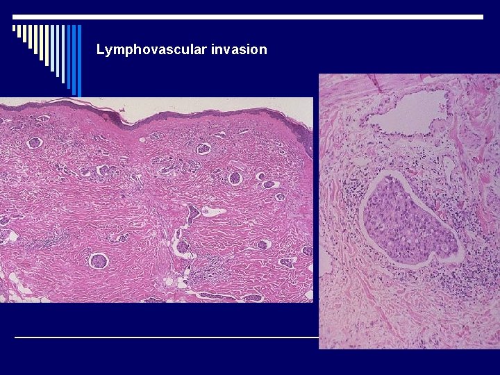 Lymphovascular invasion 