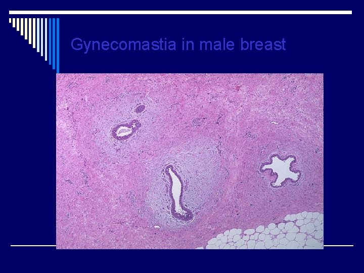 Gynecomastia in male breast 