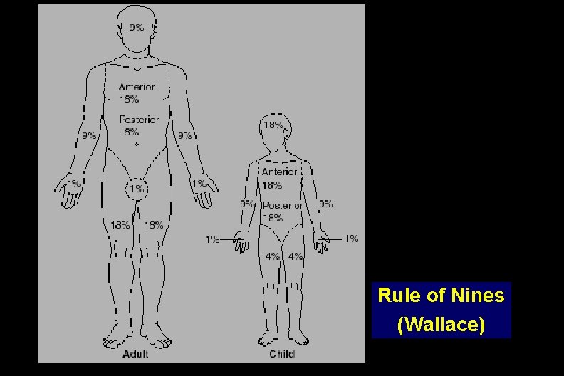 Rule of Nines (Wallace) 