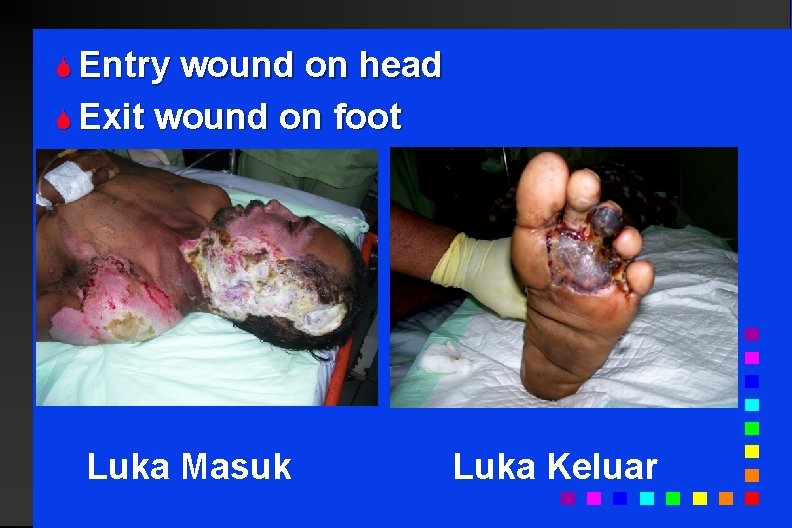 S Entry wound on head S Exit wound on foot Electrical Injuries Luka Masuk