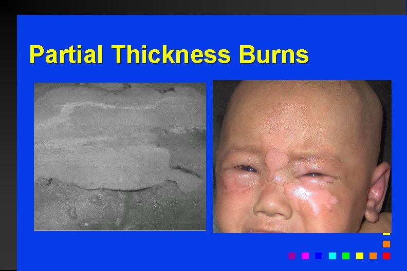 Partial Thickness Burns 