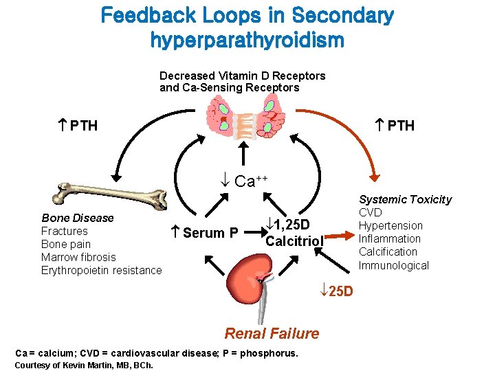 Feedback Loops in Secondary hyperparathyroidism Decreased Vitamin D Receptors and Ca-Sensing Receptors PTH Ca++