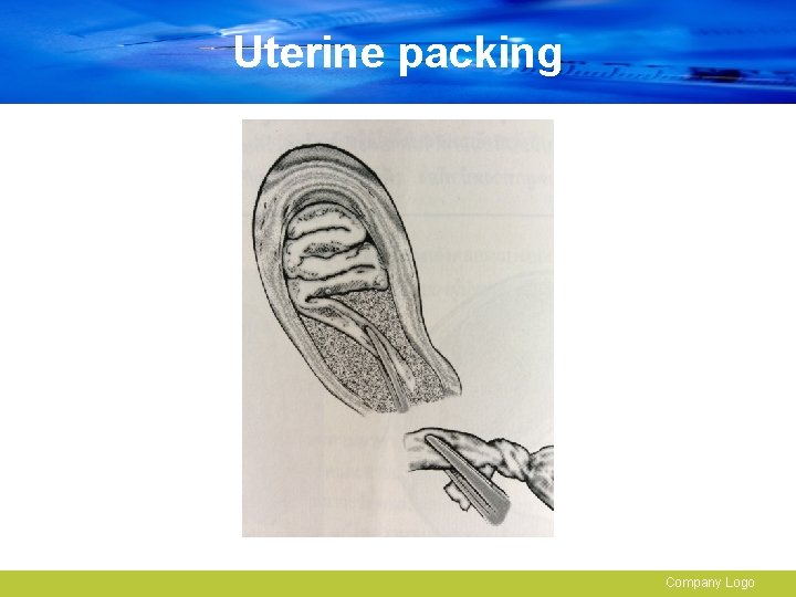 Uterine packing Company Logo 