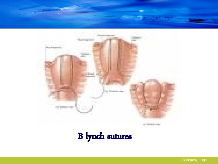 B lynch sutures Company Logo 