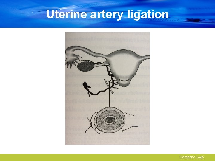 Uterine artery ligation Company Logo 