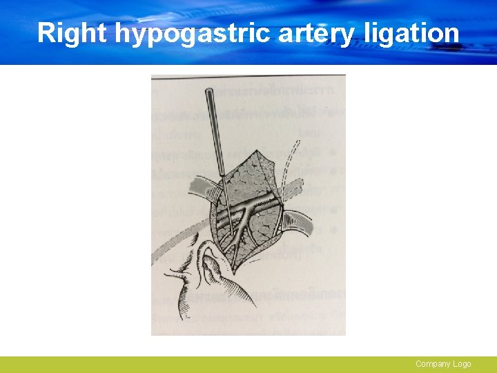 Right hypogastric artery ligation Company Logo 