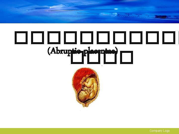������ (Abruptio placentae) ���� Company Logo 