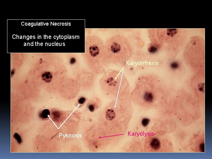 Coagulative Necrosis Changes in the cytoplasm and the nucleus Karyorrhexis Pyknosis Karyolysis 