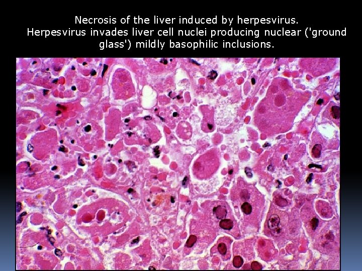 Necrosis of the liver induced by herpesvirus. Herpesvirus invades liver cell nuclei producing nuclear