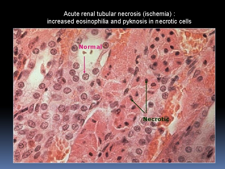 Acute renal tubular necrosis (ischemia) : increased eosinophilia and pyknosis in necrotic cells Normal Acute renal tubular necrosis (ischemia) : increased eosinophilia and pyknosis in necrotic cells Normal