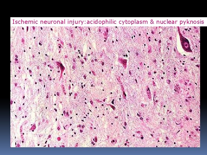Ischemic neuronal injury: acidophilic cytoplasm & nuclear pyknosis 