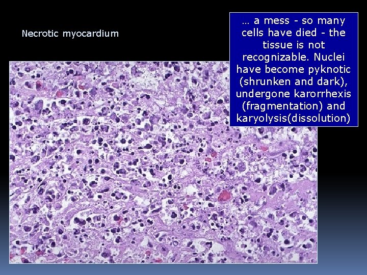 Necrotic myocardium … a mess - so many cells have died - the tissue Necrotic myocardium … a mess - so many cells have died - the tissue
