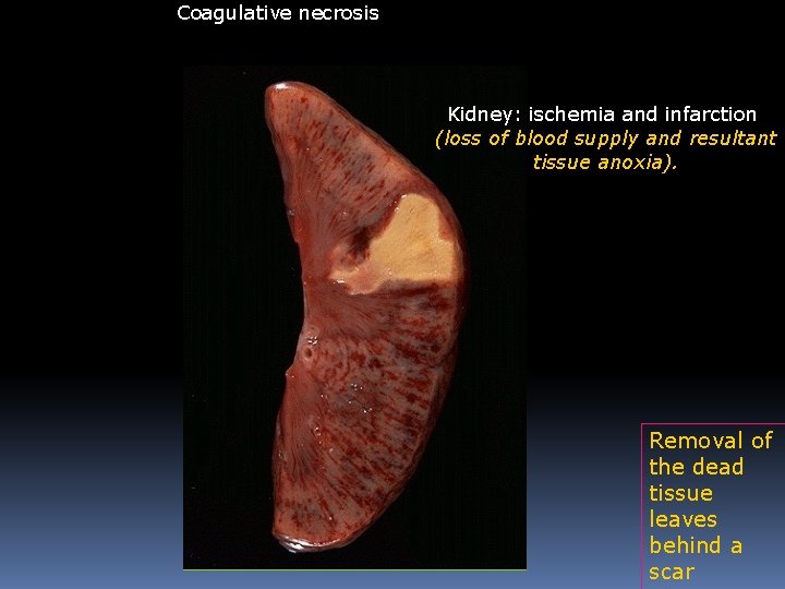 Coagulative necrosis Kidney: ischemia and infarction (loss of blood supply and resultant tissue anoxia). Coagulative necrosis Kidney: ischemia and infarction (loss of blood supply and resultant tissue anoxia).