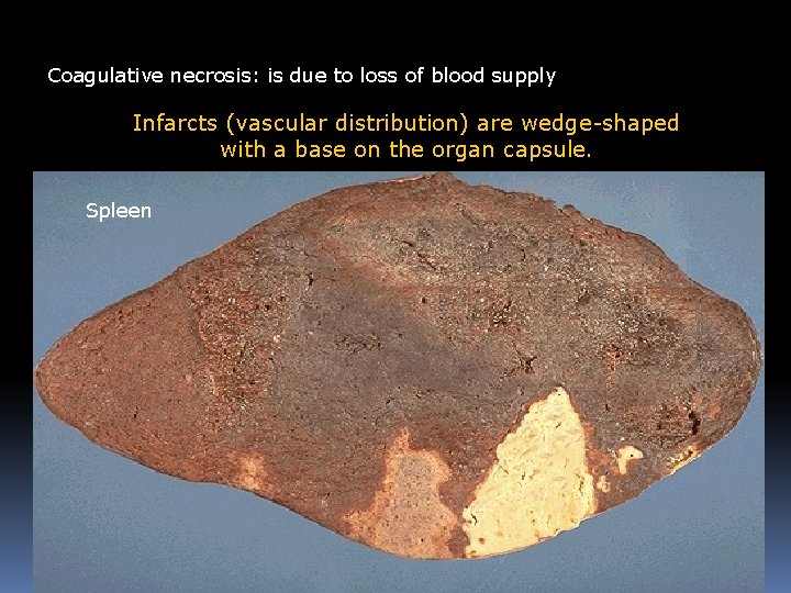 Coagulative necrosis: is due to loss of blood supply Infarcts (vascular distribution) are wedge-shaped