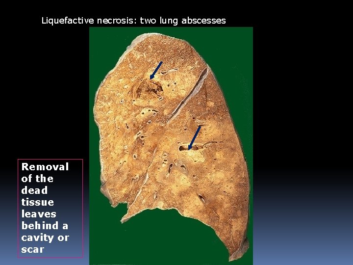 Liquefactive necrosis: two lung abscesses Removal of the dead tissue leaves behind a cavity Liquefactive necrosis: two lung abscesses Removal of the dead tissue leaves behind a cavity