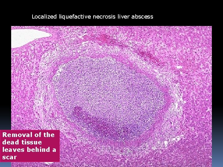 Localized liquefactive necrosis liver abscess Removal of the dead tissue leaves behind a scar Localized liquefactive necrosis liver abscess Removal of the dead tissue leaves behind a scar