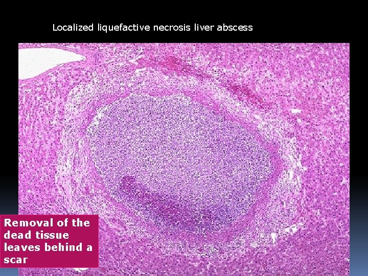 Localized liquefactive necrosis liver abscess Removal of the dead tissue leaves behind a scar