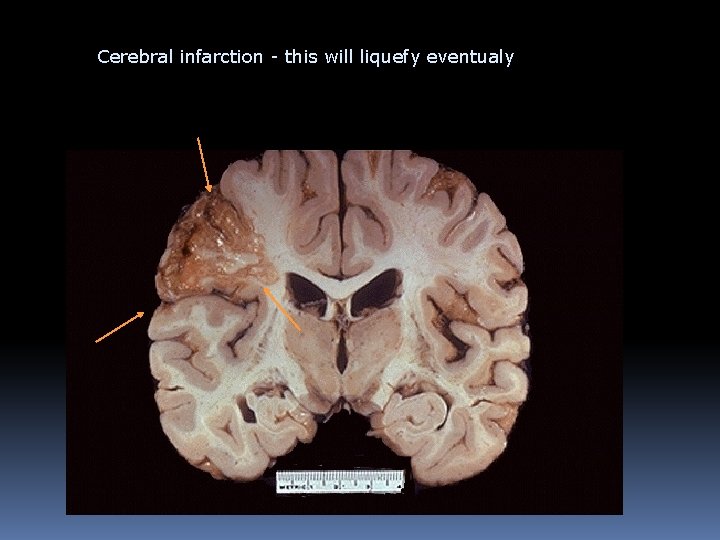 Cerebral infarction - this will liquefy eventualy 