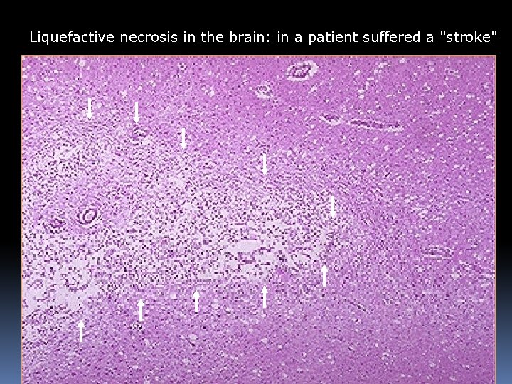 Liquefactive necrosis in the brain: in a patient suffered a "stroke" Liquefactive necrosis in the brain: in a patient suffered a "stroke"