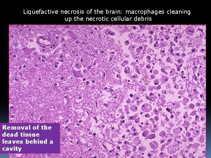Liquefactive necrosis of the brain: macrophages cleaning up the necrotic cellular debris Removal of