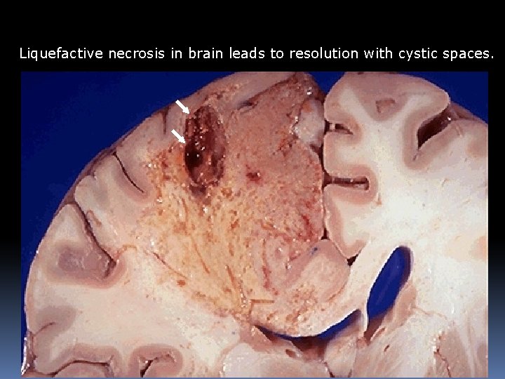 Liquefactive necrosis in brain leads to resolution with cystic spaces. Liquefactive necrosis in brain leads to resolution with cystic spaces.