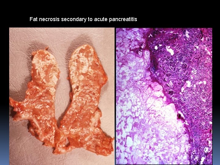 Fat necrosis secondary to acute pancreatitis 