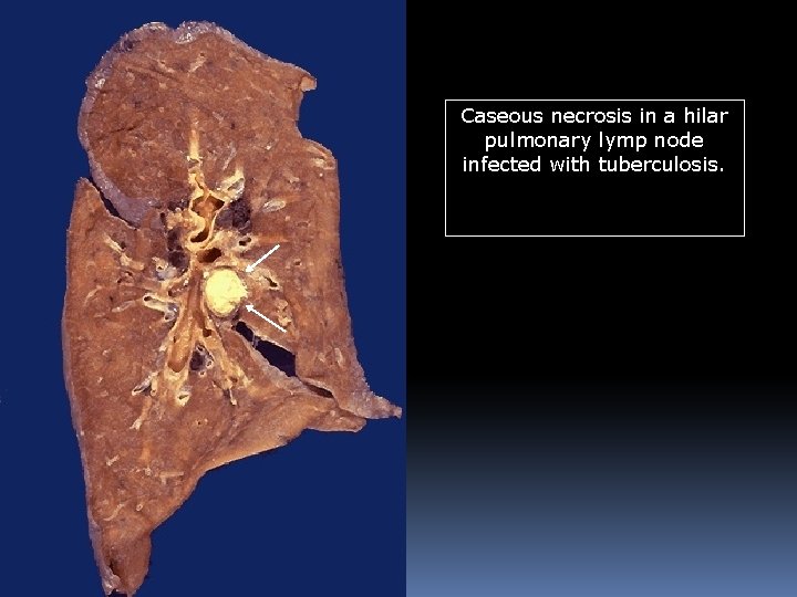 Caseous necrosis in a hilar pulmonary lymp node infected with tuberculosis. 