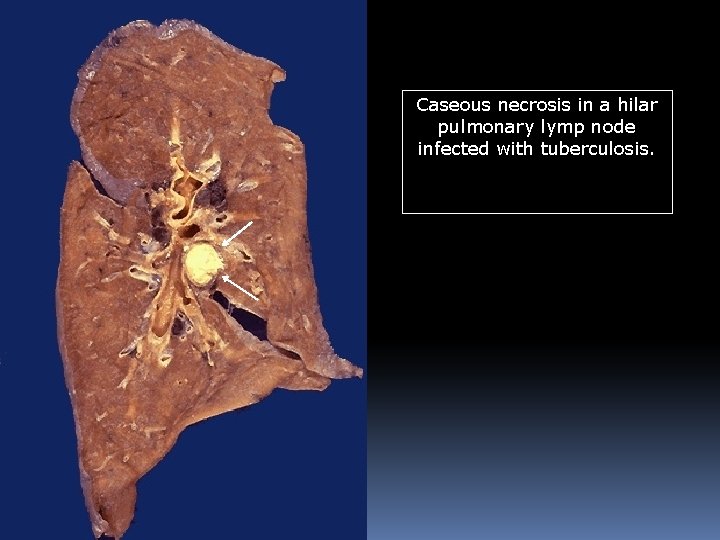 Caseous necrosis in a hilar pulmonary lymp node infected with tuberculosis. Caseous necrosis in a hilar pulmonary lymp node infected with tuberculosis.