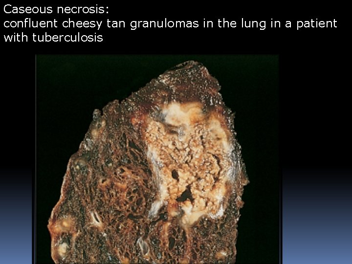 Caseous necrosis: confluent cheesy tan granulomas in the lung in a patient with tuberculosis Caseous necrosis: confluent cheesy tan granulomas in the lung in a patient with tuberculosis