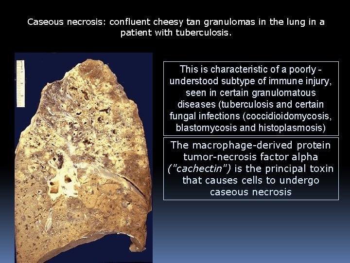 Caseous necrosis: confluent cheesy tan granulomas in the lung in a patient with tuberculosis.