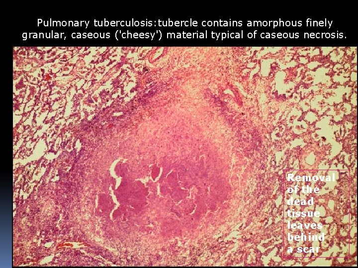 Pulmonary tuberculosis: tubercle contains amorphous finely granular, caseous ('cheesy') material typical of caseous necrosis.
