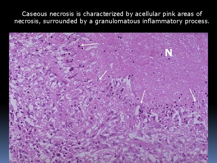 Caseous necrosis is characterized by acellular pink areas of necrosis, surrounded by a granulomatous