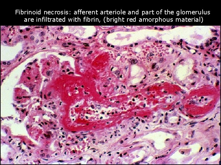 Fibrinoid necrosis: afferent arteriole and part of the glomerulus are infiltrated with fibrin, (bright
