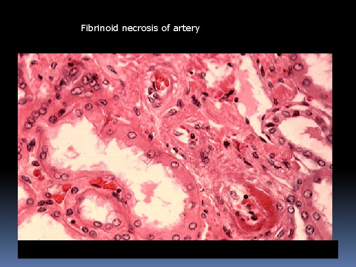 Fibrinoid necrosis of artery 