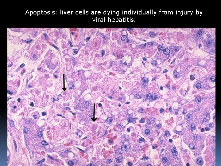 Apoptosis: liver cells are dying individually from injury by viral hepatitis. 