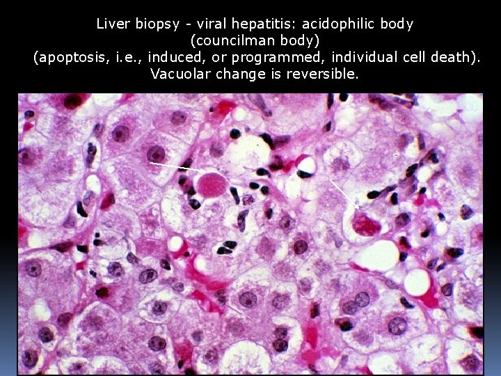 Liver biopsy - viral hepatitis: acidophilic body (councilman body) (apoptosis, i. e. , induced,