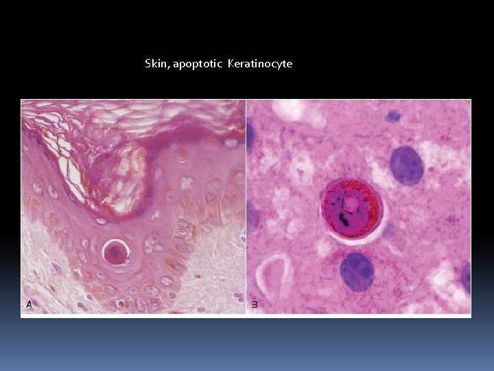 Skin, apoptotic Keratinocyte 