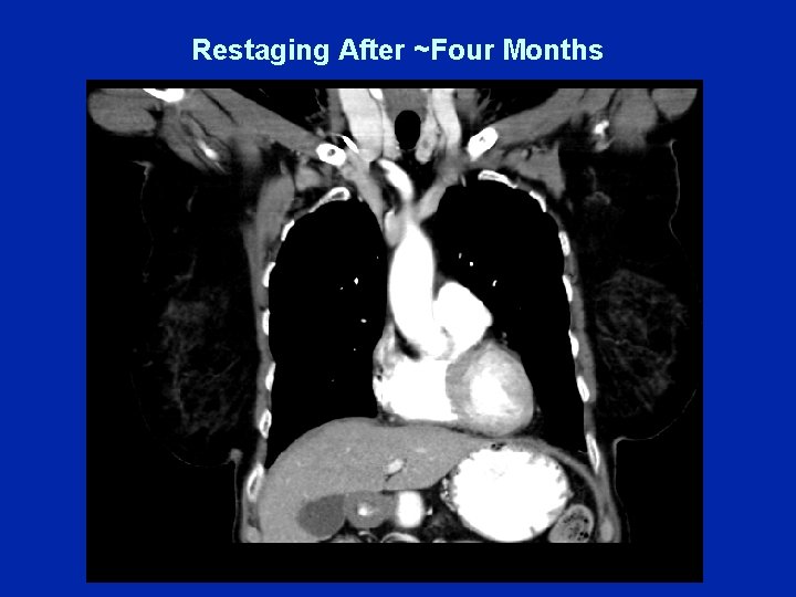 Restaging After ~Four Months 