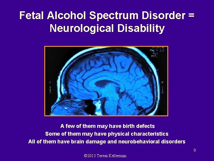 Fetal Alcohol Spectrum Disorder = Neurological Disability A few of them may have birth