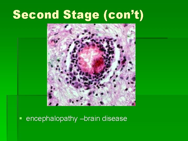 Second Stage (con’t) § encephalopathy –brain disease 