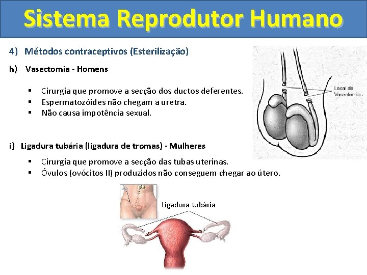 Sistema Reprodutor Humano 4) Métodos contraceptivos (Esterilização) h) Vasectomia - Homens § § §