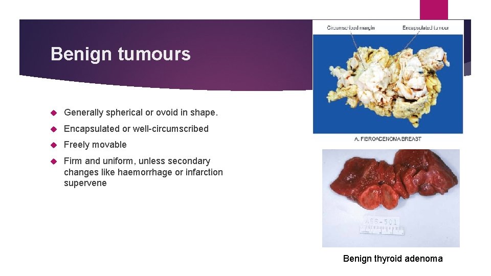 Benign tumours Generally spherical or ovoid in shape. Encapsulated or well-circumscribed Freely movable Firm