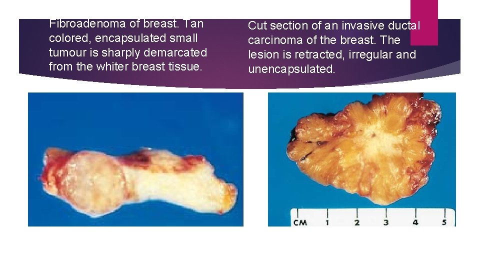 Fibroadenoma of breast. Tan colored, encapsulated small tumour is sharply demarcated from the whiter