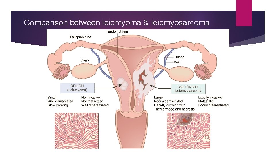Comparison between leiomyoma & leiomyosarcoma 
