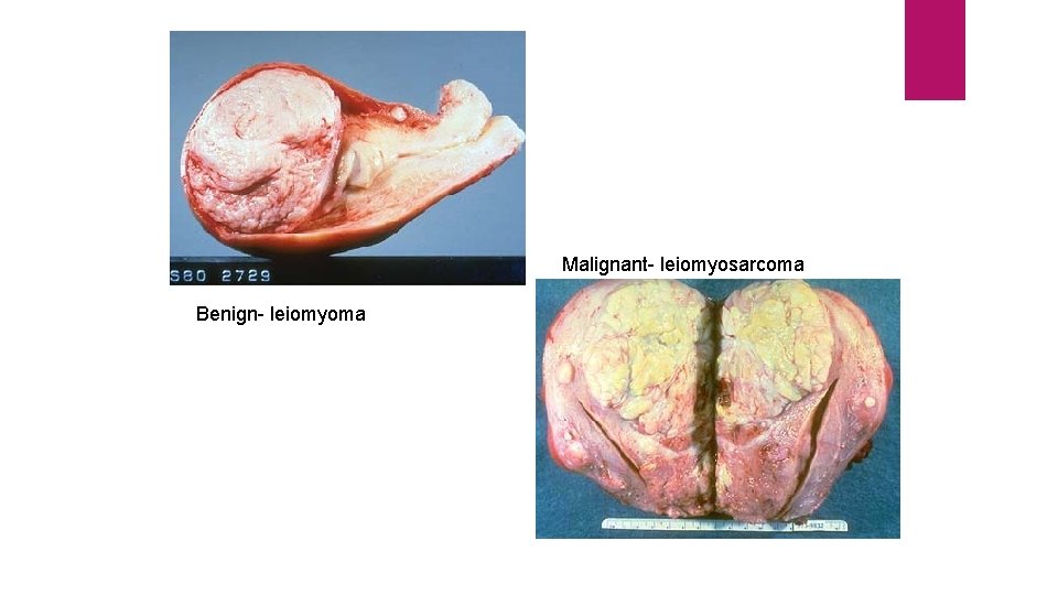 Malignant- leiomyosarcoma Benign- leiomyoma 
