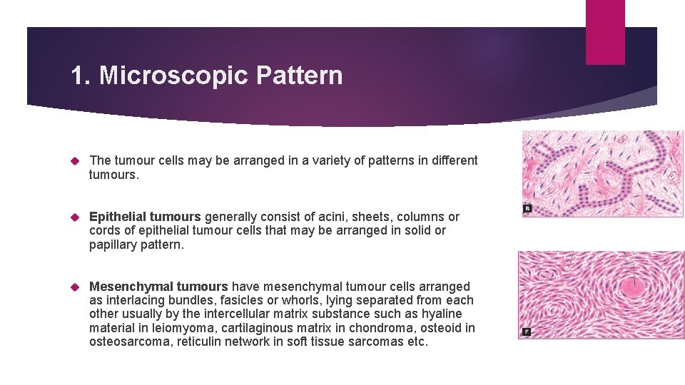 1. Microscopic Pattern The tumour cells may be arranged in a variety of patterns
