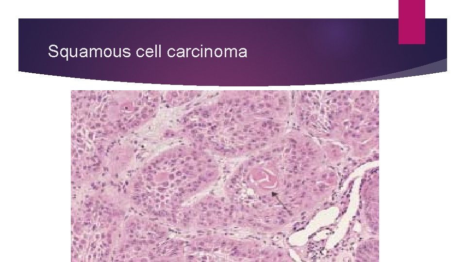 Squamous cell carcinoma 